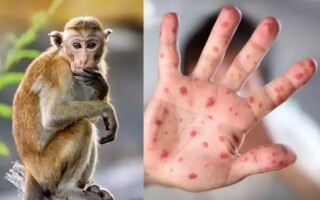Réunion on Health Alert After Monkeypox Case Confirmed