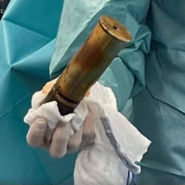 Doctors in France remove artillery shell from patient